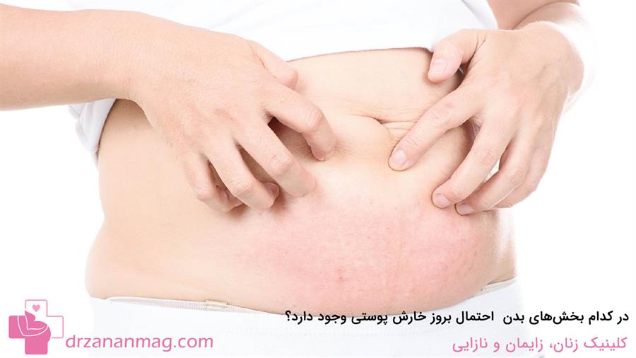 بخش‌هایی از بدن که احتمال بروز خارش‌های پوستی در آنها در دوران بارداری وجود دارد