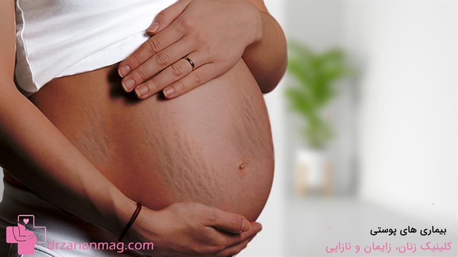 تاثیر بیماری‌های پوستی بر خارش پوستی در بارداری