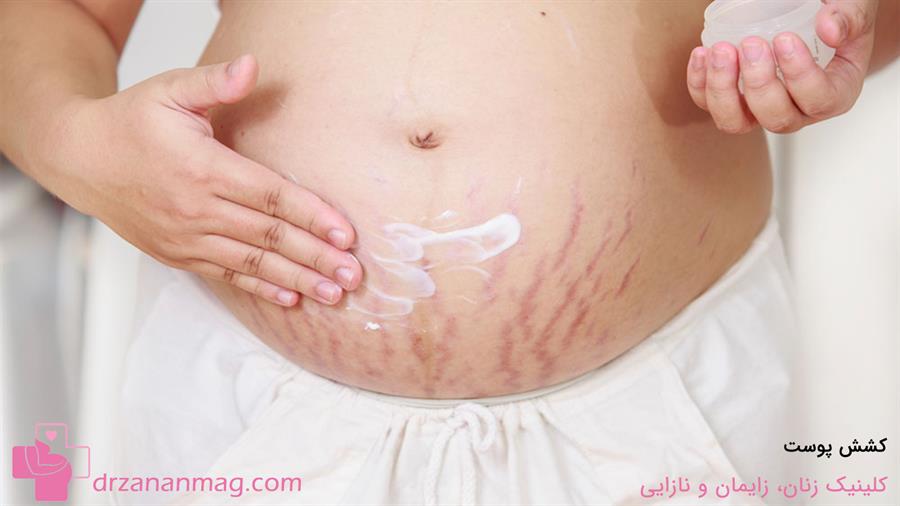 تاثیر کشش پوست بر خارش پوست در بارداری