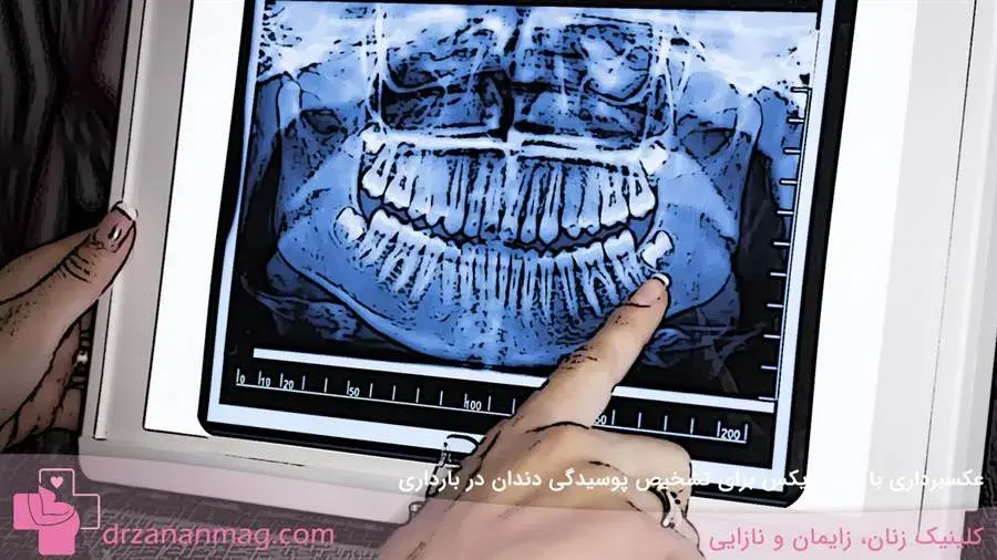 آیا استفاده از اشعه ایکس برای تشخیص پوسیدگی دندان در بارداری مجاز است؟
