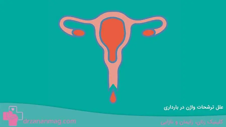 بررسی علت ترشحات واژن در حاملگی