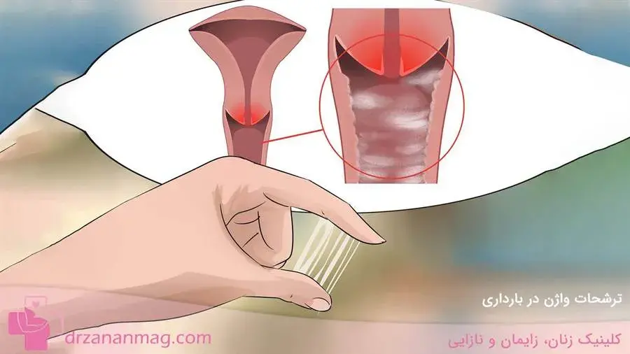 ترشحات واژن در حاملگی