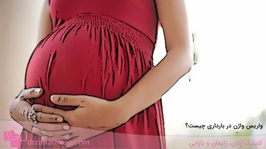 آشنایی با واریس واژن در حاملگی