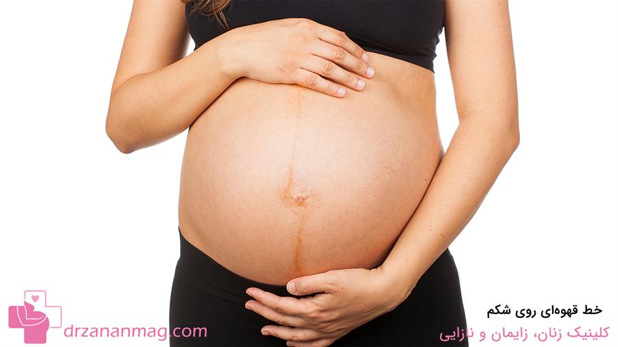 خط قهوه‌ای روی شکم از تغییرات پوستی در بارداری