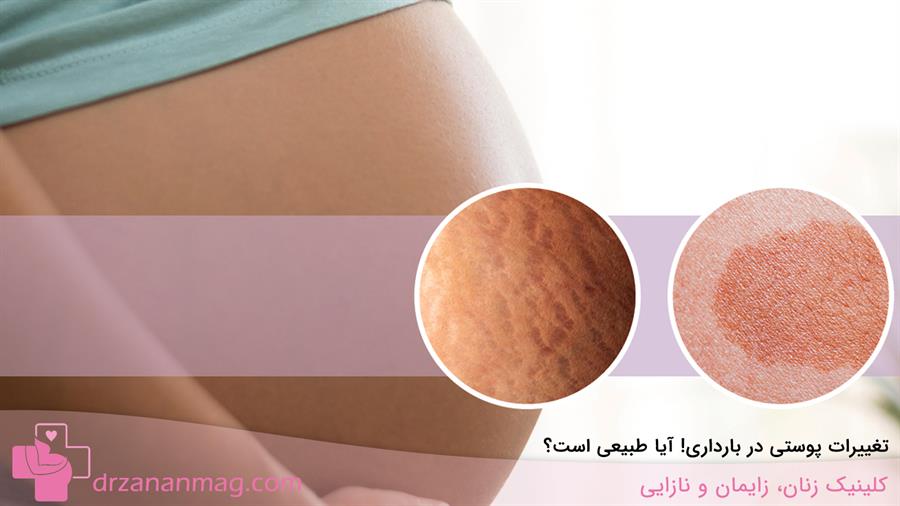 ایا تغییرات پوستی در بارداری طبیعی است؟