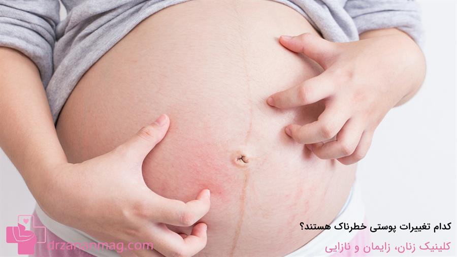 تغییرات پوستی هشدار دهنده در بارداری