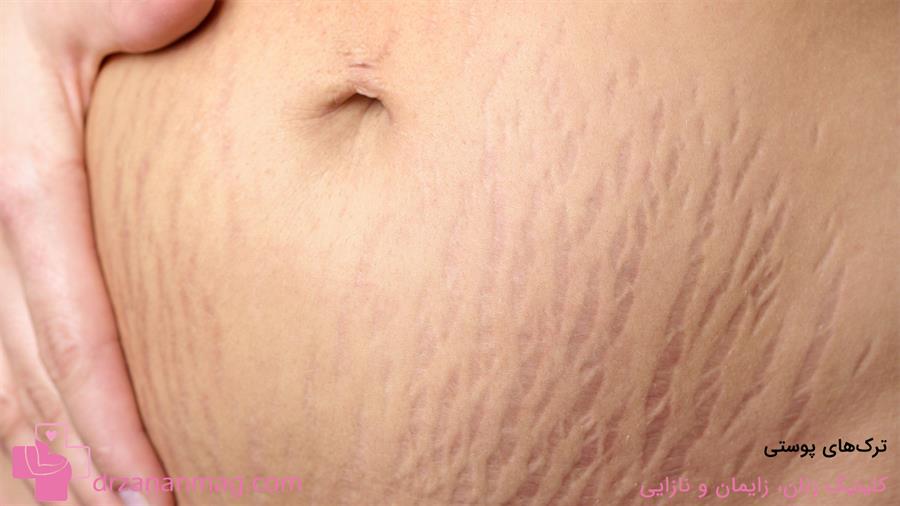 ترک‌های پوستی از تغییرات پوستی در بارداری