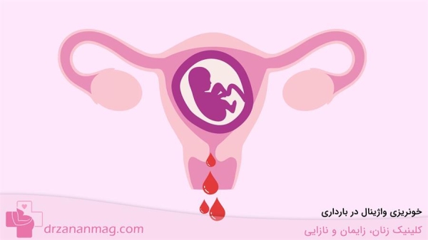 خونریزی واژینال در بارداری
