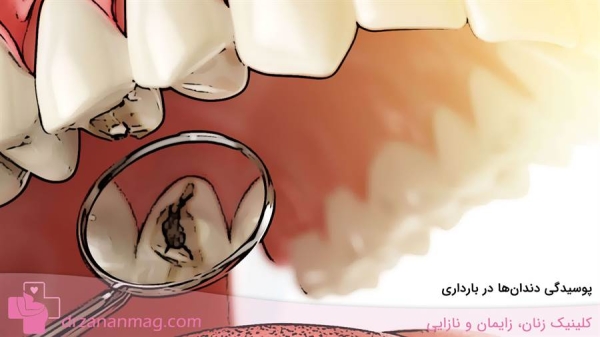 پوسیدگی دندان در بارداری
