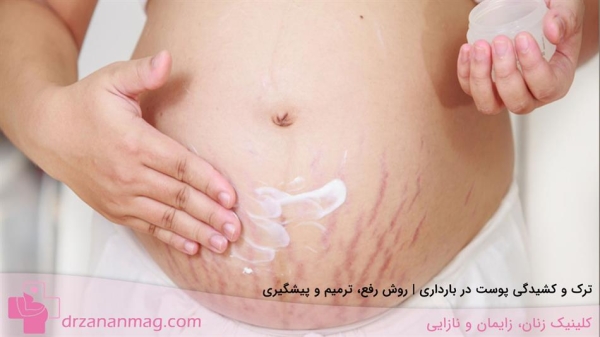 ترک و کشیدگی پوست در بارداری | روش رفع، ترمیم و پیشگیری